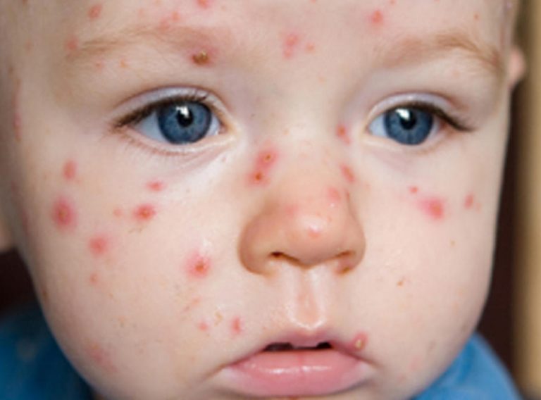 kizil-hastaligi kizil-hastaligi